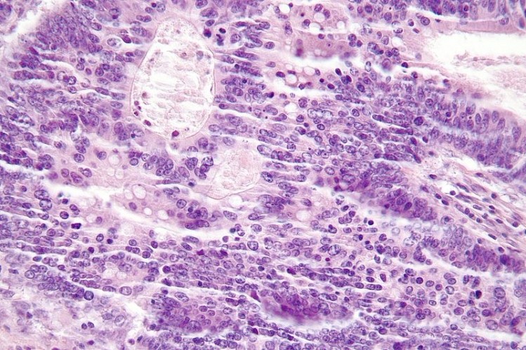 TILs in colorectal carcinoma