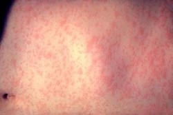 Measles: a moral choice