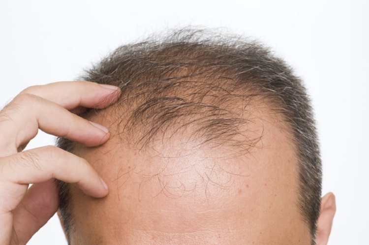 First-in-man study appears to 'awaken' dormant hair follicles, says biotech